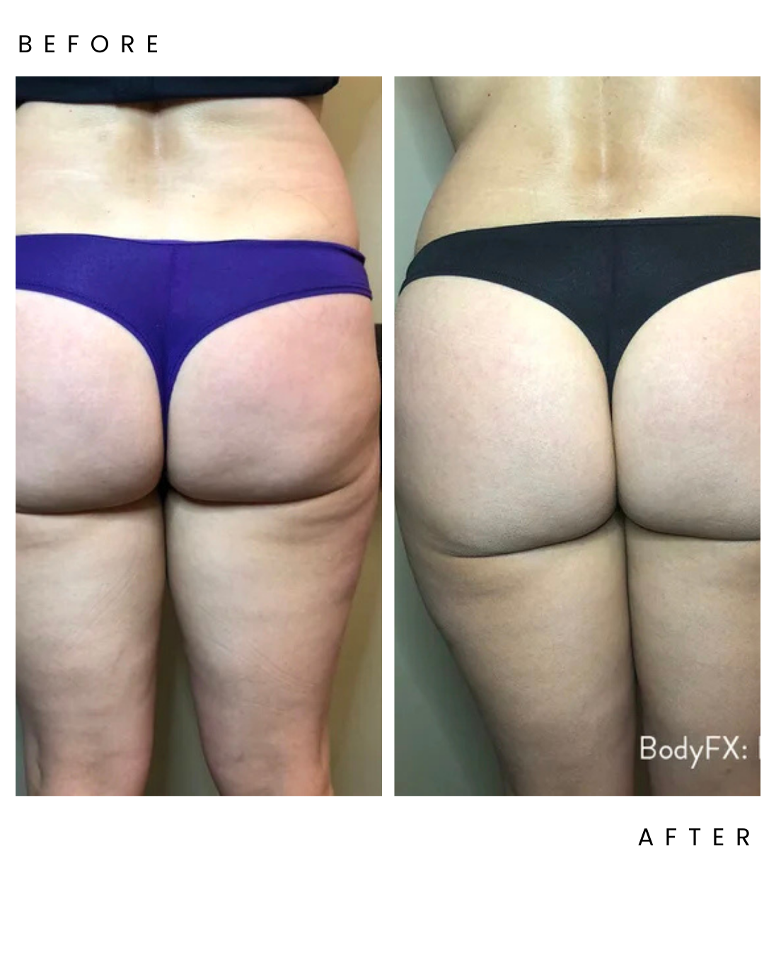 Cellulite & Body Contouring in Cambridge, ON — Mimada Beauty